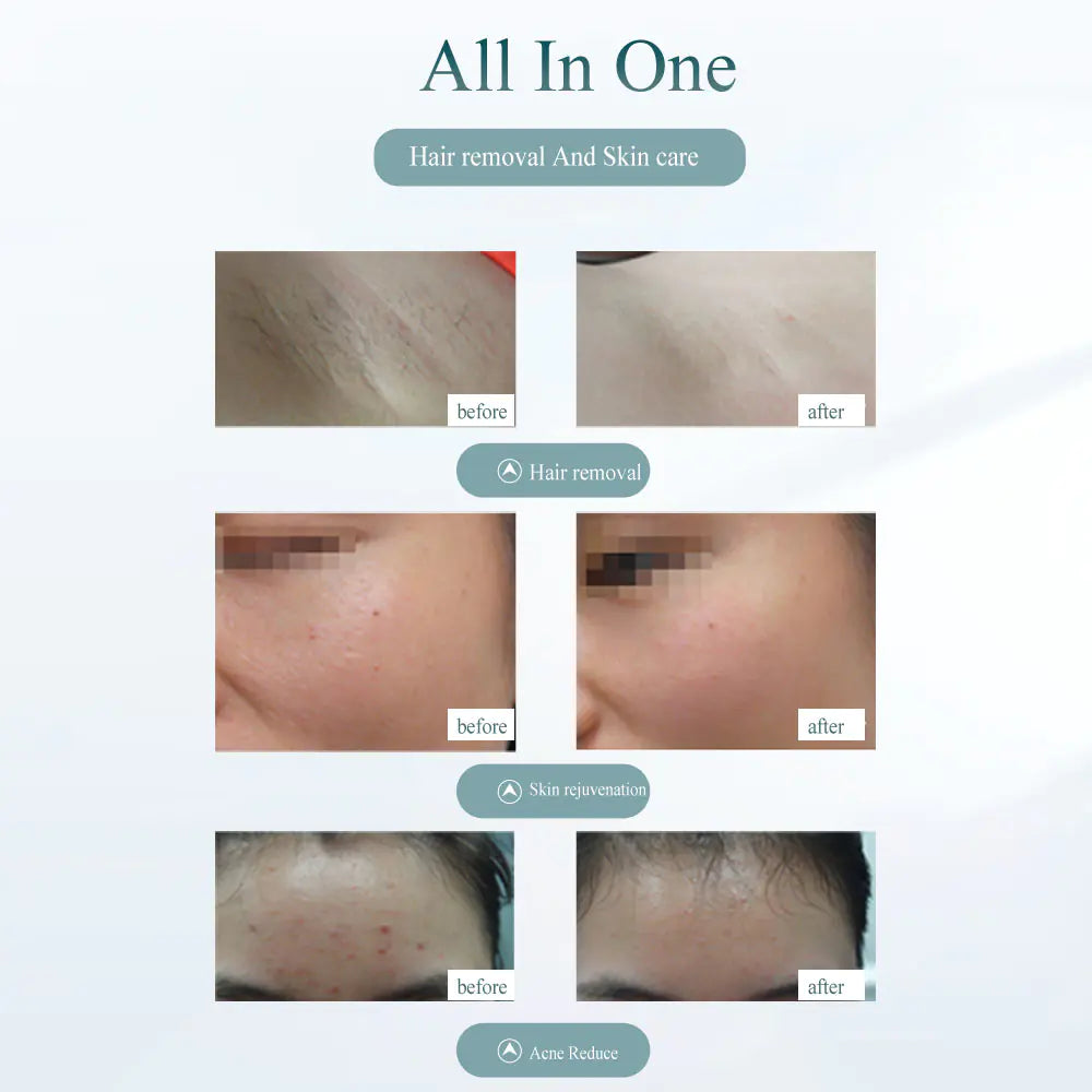 Laser Hair Removal Device - Painless Hair Removal Tool